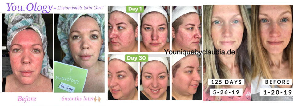 Younique Youology Hautpflege Ergebnisse vorher nachher 