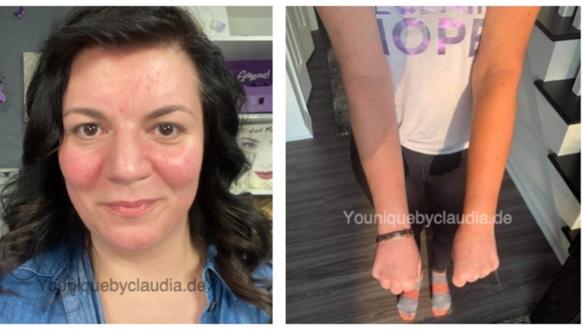 Younique Beachfront Selbstbräuner sensible Haut Rosazea Couperose Neurodermitis Schuppenflechte Tanning Drops Erfahrungsbericht Tipps und Tricks