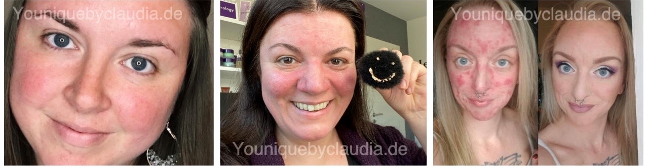 Younique Youology 2 Rosazea Rosacea Neurodermitis Schuppenflechte Couperose