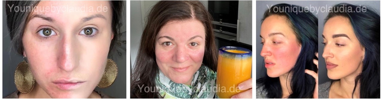 Younique Youology 3 Rosazea Rosacea Neurodermitis Schuppenflechte Couperose
