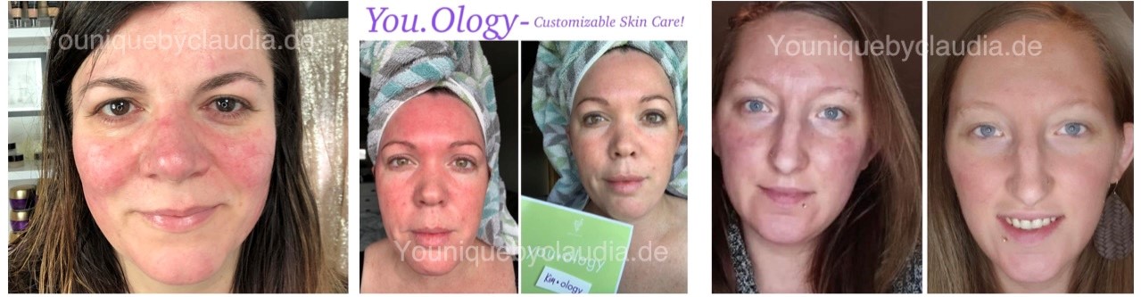 Younique Youology 7 Rosazea Rosacea Neurodermitis Schuppenflechte Couperose