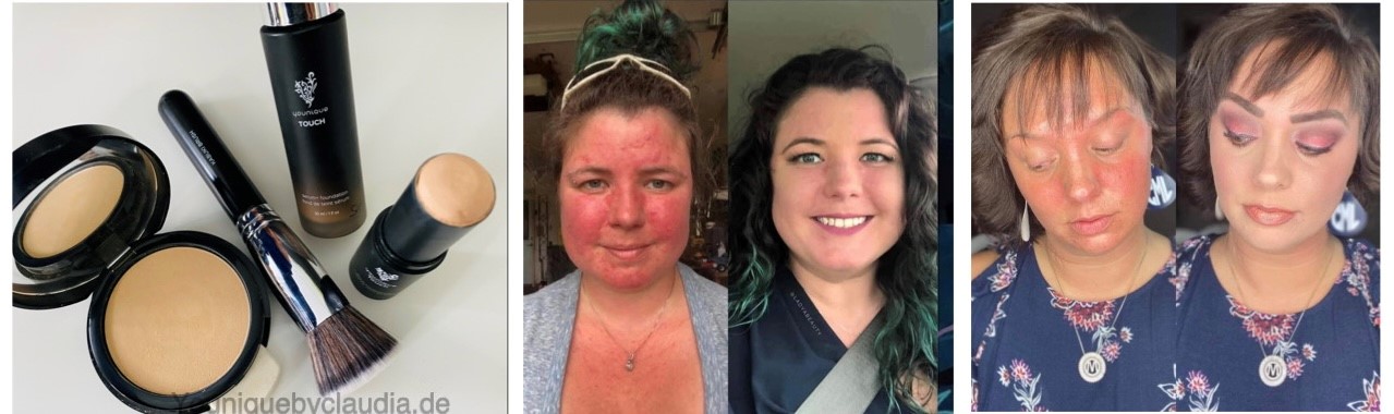 Younique Erfahrungsbericht Rosazea Neurodermitis Schuppenflechte vorher nachher